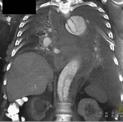 Aortic Dissection - CTisus CT Scan