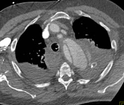 Aortic Dissection - CTisus CT Scan