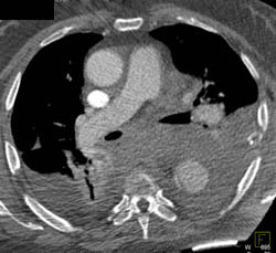 Aortic Dissection - CTisus CT Scan