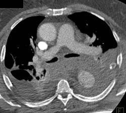 Aortic Dissection - CTisus CT Scan