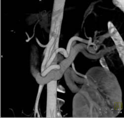 Ectatic Splenic Artery - CTisus CT Scan