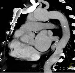 Aortic Arch Aneurysm With Intramural Hematoma Descending Aorta - CTisus CT Scan