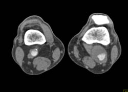 Popliteal Artery Aneurysm - CTisus CT Scan