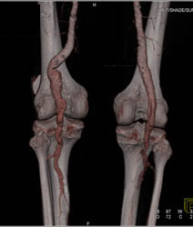 Popliteal Artery Aneurysm - CTisus CT Scan