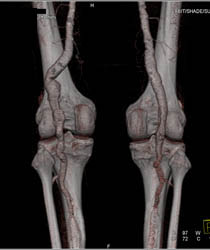 Popliteal Artery Aneurysm - CTisus CT Scan