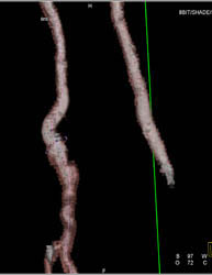 Popliteal Artery Aneurysm - CTisus CT Scan