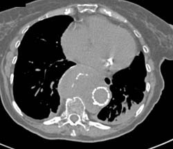 Aortic Ulcer in Aneurysm - CTisus CT Scan