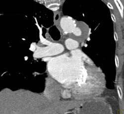 Ulceration in Arch - CTisus CT Scan