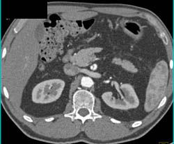 Focal Dissection SMA - CTisus CT Scan