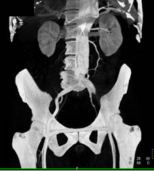 Occluded Left External Iliac Artery With Fem-fem Bypass. Note the Impact of VRT Vs MIP - CTisus CT Scan