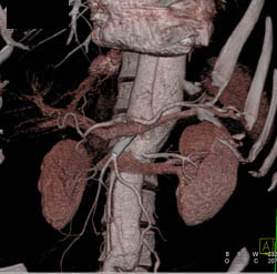 Stent in SMA With Dissection - CTisus CT Scan