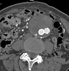 Endoleak - CTisus CT Scan