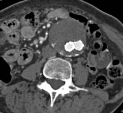 Endoleak - CTisus CT Scan