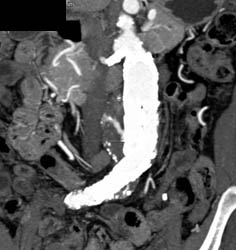 Endoleak - CTisus CT Scan