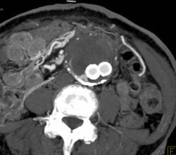 Endoleak - CTisus CT Scan