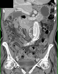 Endoleak - CTisus CT Scan