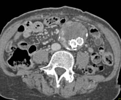 Endoleak - CTisus CT Scan