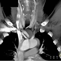 Stenosis Right Subclavian - CTisus CT Scan