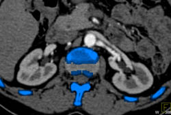 Fibromuscular Dysplasia of the Left Renal Artery- FMD - CTisus CT Scan