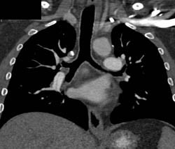 Chronic Pulmonary Embolism (PE) With Web in Right Pulmonary Artery - CTisus CT Scan