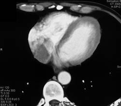 Thrombus Extends From Renal Vein to IVC to Right Atrium in Renal Cell Carcinoma - CTisus CT Scan