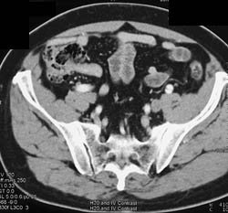 Dissection in Left External Iliac Artery - CTisus CT Scan