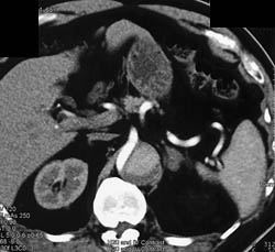 Aortic Dissection - CTisus CT Scan