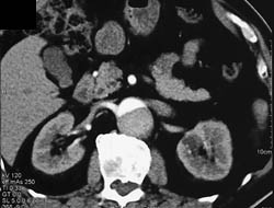 Aortic Dissection - CTisus CT Scan