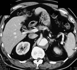 Aortic Dissection - CTisus CT Scan