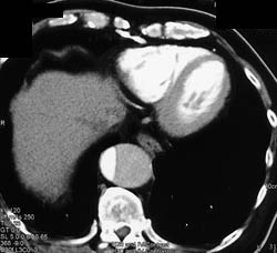 Aortic Dissection - CTisus CT Scan