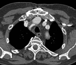 Type A Dissection - CTisus CT Scan