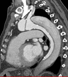 Type A Dissection - CTisus CT Scan