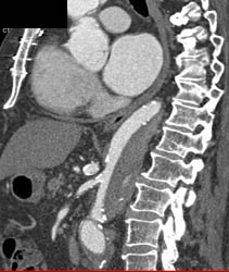 Type A Dissection - CTisus CT Scan