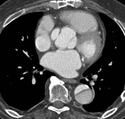 Type A Dissection - CTisus CT Scan