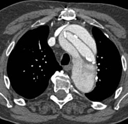 Type A Dissection - CTisus CT Scan