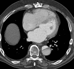 Type A Dissection - CTisus CT Scan