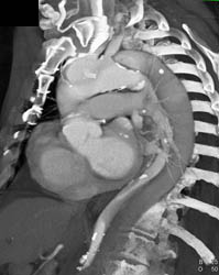 Type A Dissection - CTisus CT Scan