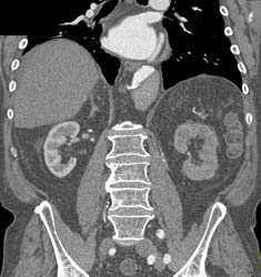 Type A Dissection - CTisus CT Scan