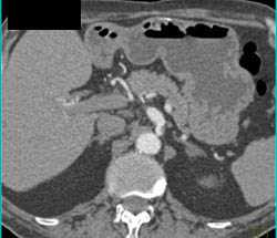 Celiac Artery Aneurysm - CTisus CT Scan