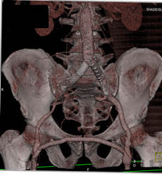 Fem-fem Bypass With Occluded Right Iliac Artery - CTisus CT Scan