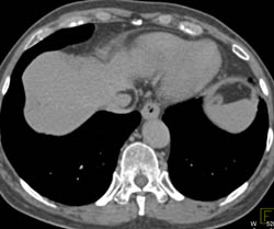 Pseudo Clot Inferior Vena Cava (IVC) - CTisus CT Scan