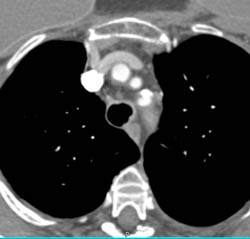 Pseudo clot in SVC - CTisus CT Scan