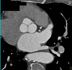 Pulmonary Embolism - CTisus CT Scan