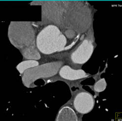 Greater Than 50% Stenosis of Left Anterior Descending-LAD- Coronary Artery - CTisus CT Scan