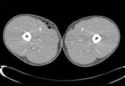 Normal Superficial Femoral Artery (SFA) Branching - CTisus CT Scan