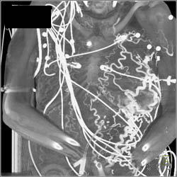 Collaterals Due to SVC Occlusion - CTisus CT Scan