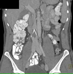 IVC Stent and Thrombus - CTisus CT Scan