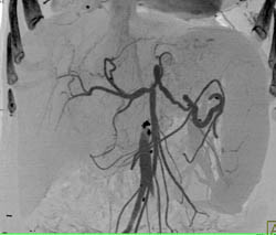 Encased Splenic Artery - CTisus CT Scan