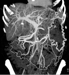 Occlusion of Splenic Vein With Collaterals - CTisus CT Scan