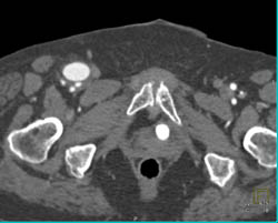 Pseudoaneurysm Off Femoral Artery - CTisus CT Scan